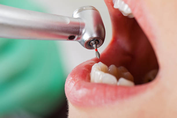 Best Emergency Root Canal Treatment in Maypearl, TX